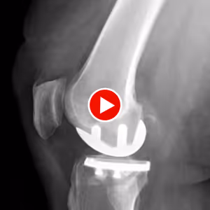 Dr Pierre DEKEUWER présente la prothèse unicompartimentaire du genou, alternative à la prothèse totale – chirurgien orthopédiste Toulon Hyères