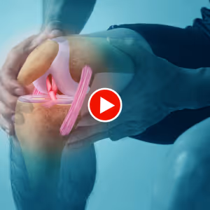 Dr Pierre DEKEUWER explique la ligamentoplastie du ligament croisé antérieur (LCA) – chirurgie du sport Hyères Toulon Var
